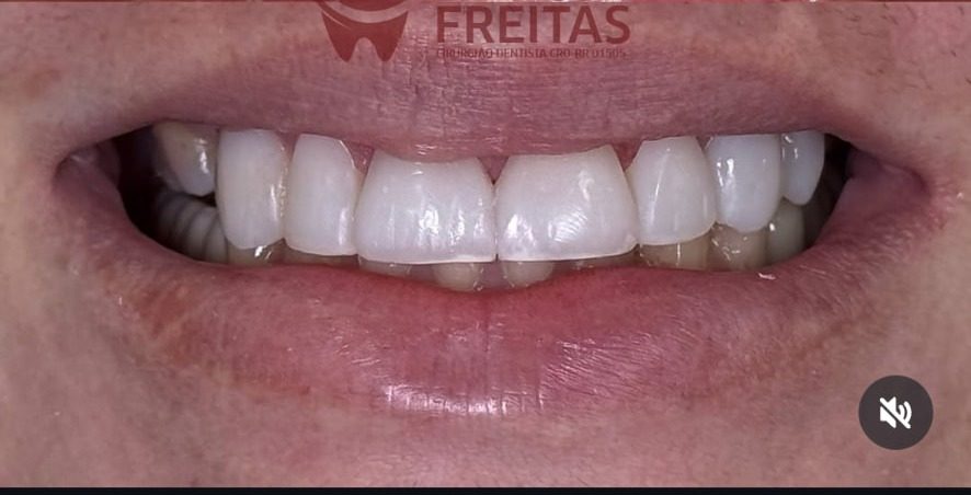 Depois do tratamento reabilitador