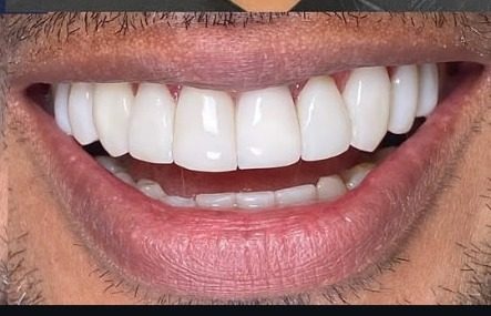 Detalhe do sorriso depois