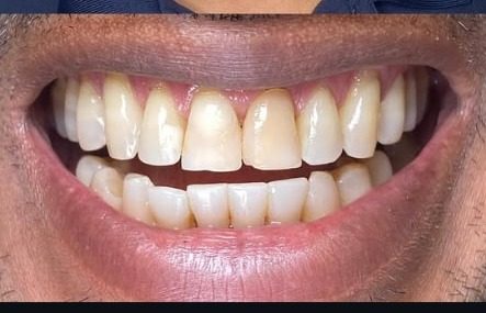 Detalhe do sorriso antes